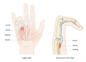 illustration-trigger-finger