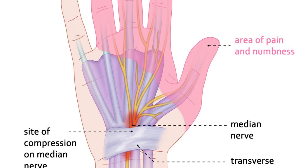 Carpal Tunnel Syndrome