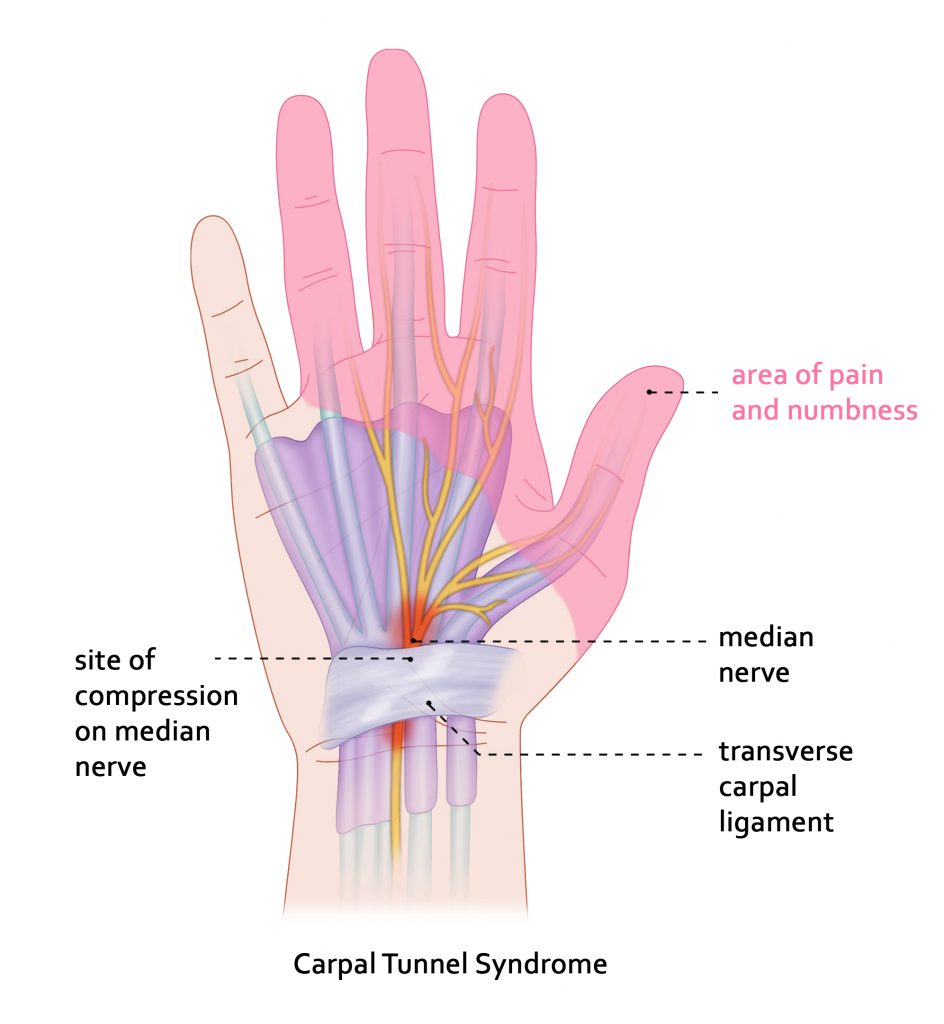 Carpal Tunnel Syndrome anatomical diagram